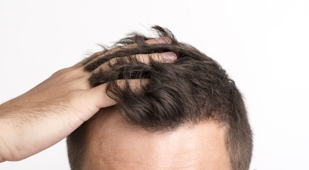 Causes and Remedies for Hair Fall in Men